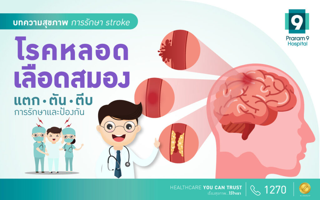 การรักษาโรคหลอดเลือดสมอง Stroke และป้องกันไม่ให้กลับมาเป็นซ้ำ