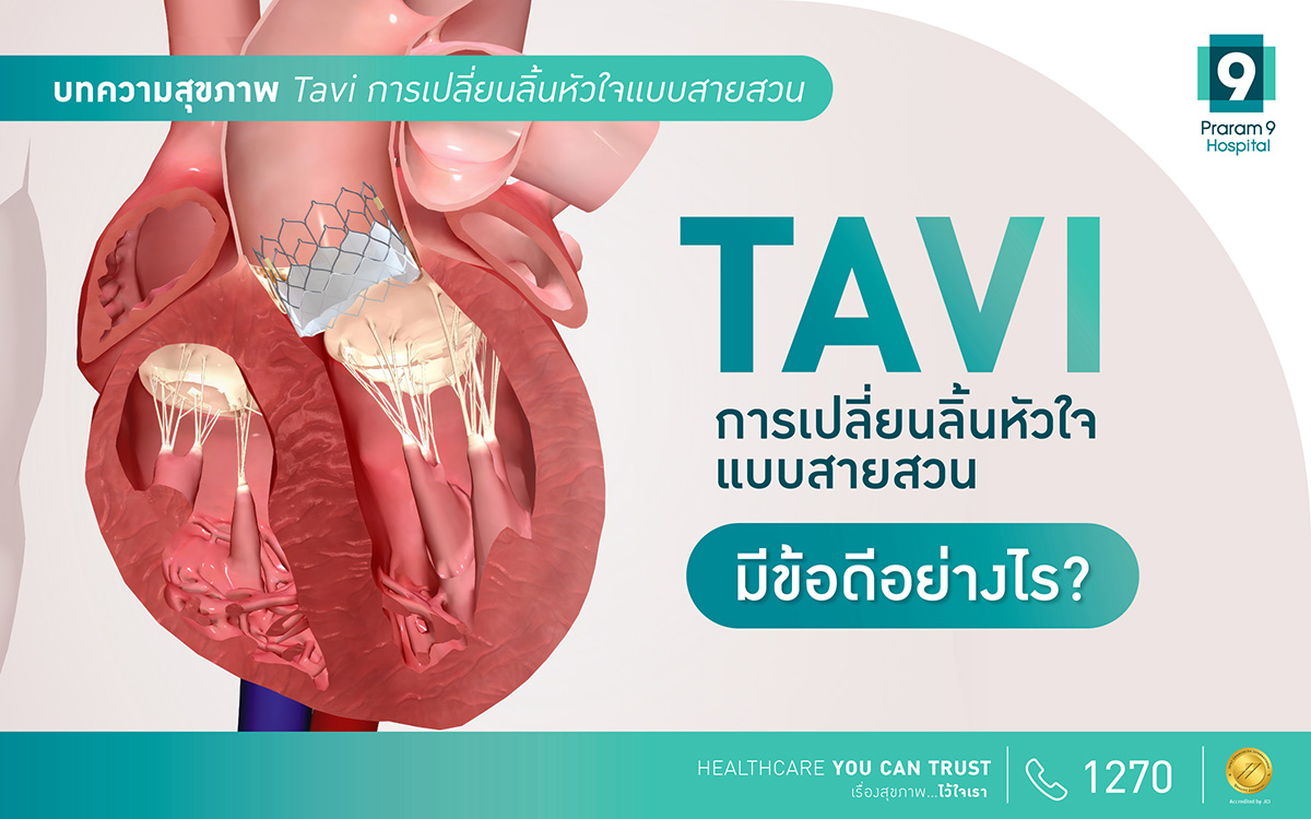 Tavi การเปลี่ยนผ่าตัดลิ้นหัวใจแบบสายสวน